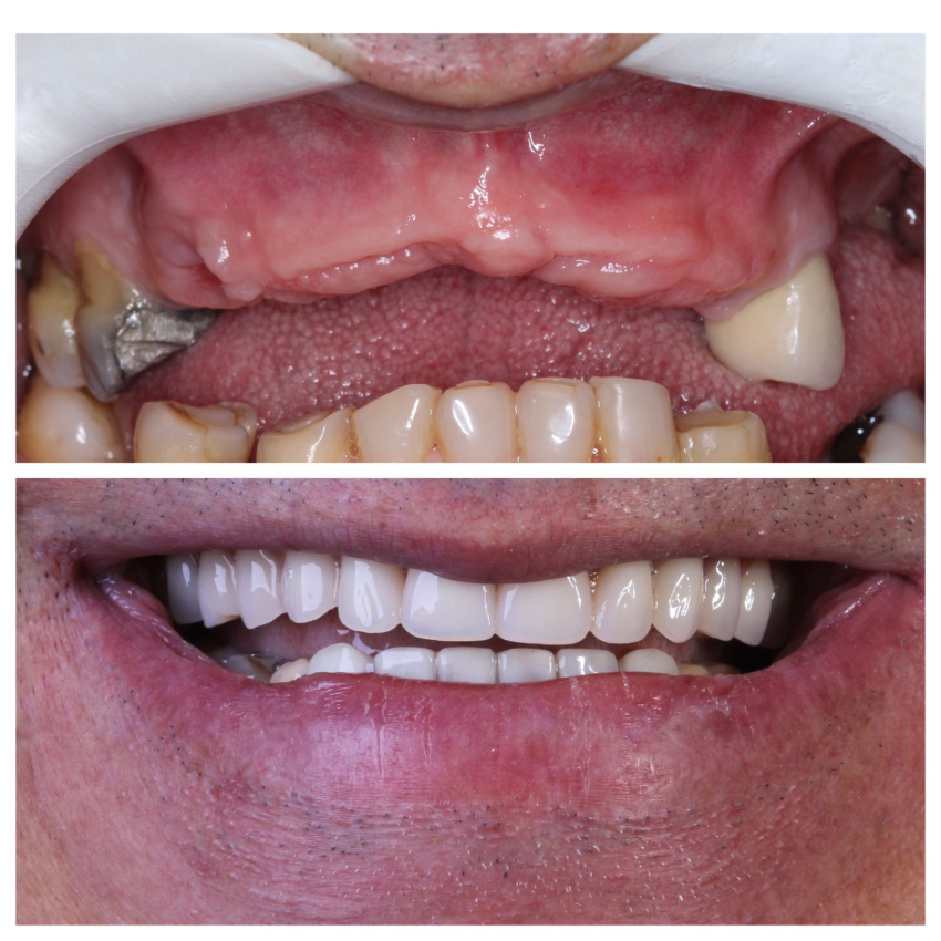 Implante Dentário em Piracicaba: tudo o que você precisa saber 